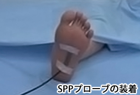 SPP検査（皮膚灌流圧）